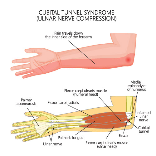cubital tunnel syndrome nz