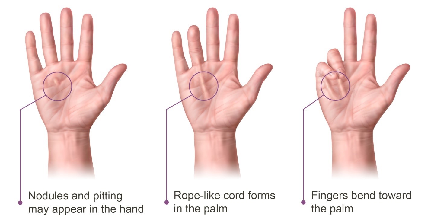 Dupuytren's Contracture Surgery