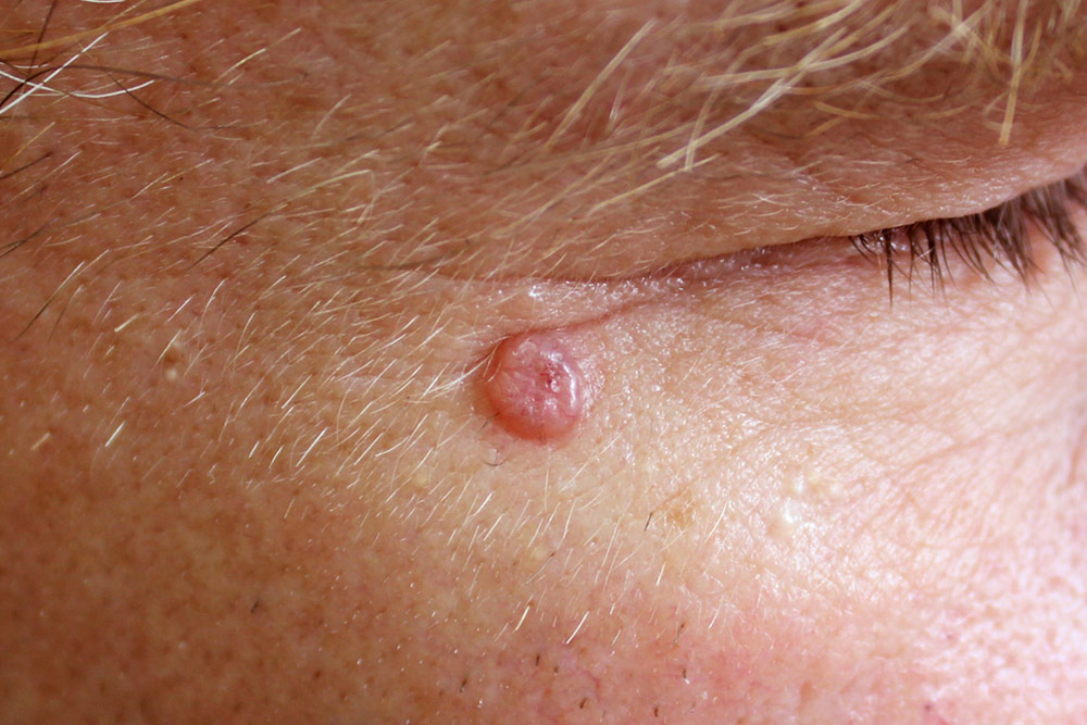 Non-Melanoma-Skin-Cancer-Header