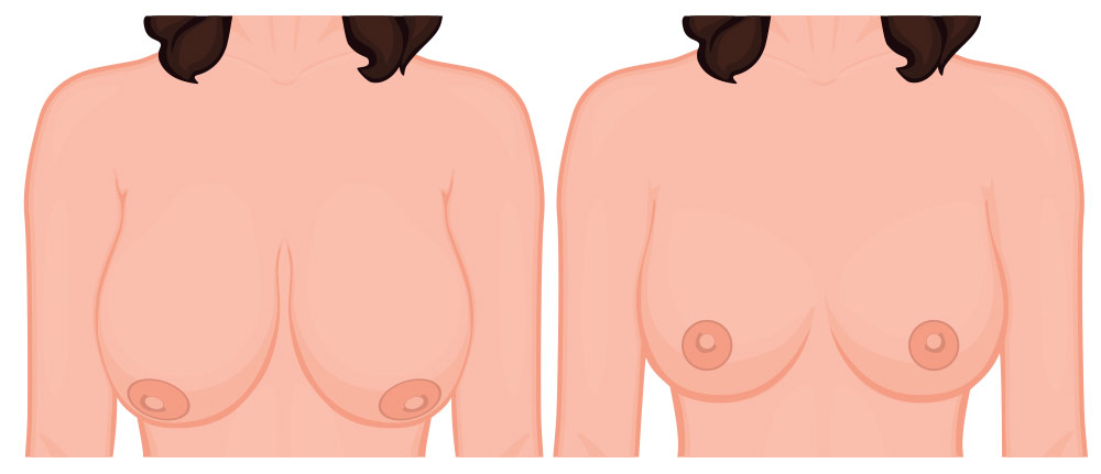breast lift diagram