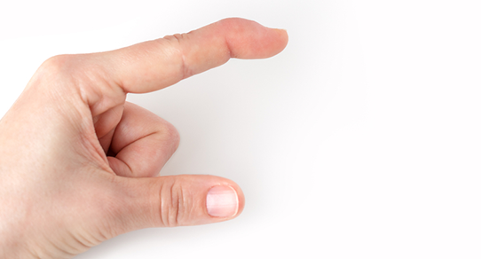 Fingertip Injuries