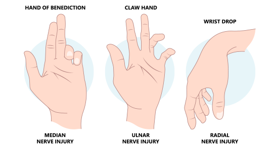 Nerve Injuries