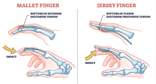 tendon repair
