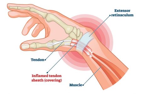 de-quervain-tenosynovitis-pain