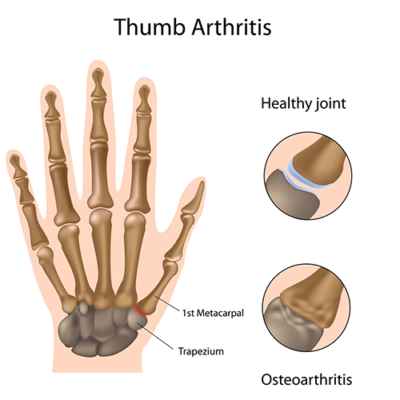 thumb base arthritis